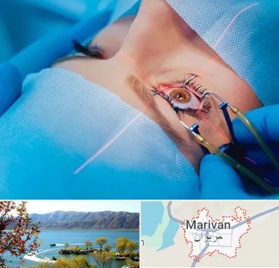 عمل prk چشم در مریوان