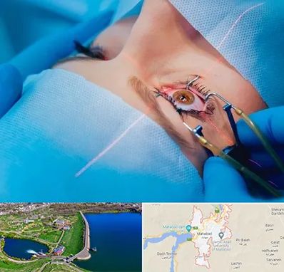 عمل prk چشم در مهاباد