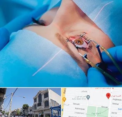 عمل prk چشم در افسریه 