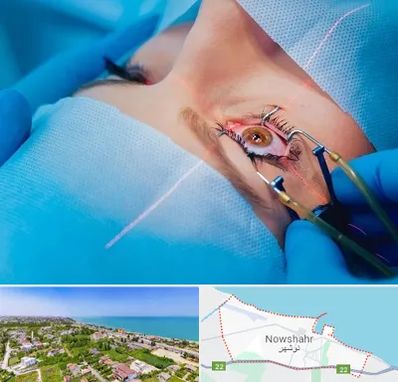 عمل prk چشم در نوشهر