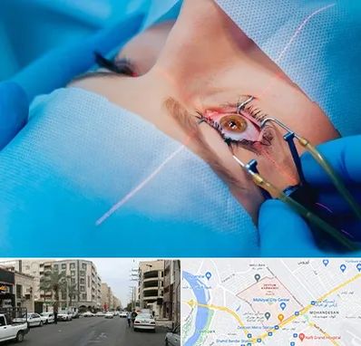 عمل prk چشم در زیتون کارمندی اهواز