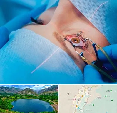 عمل prk چشم در رودبار