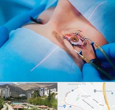 عمل prk چشم در شهر زیبا 