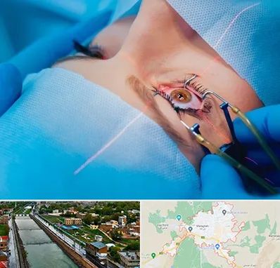 عمل prk چشم در مراغه