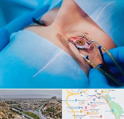 عمل prk چشم در معالی آباد شیراز