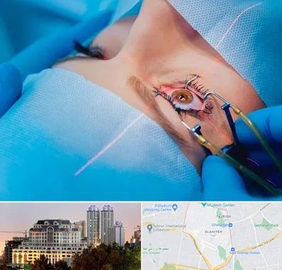 عمل prk چشم در فرشته 