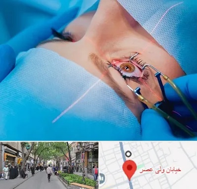 عمل prk چشم در ولیعصر شهریار