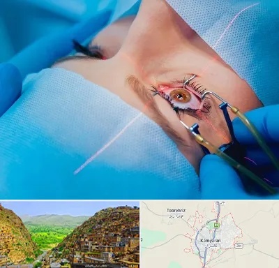 عمل prk چشم در کامیاران