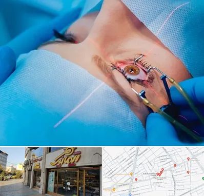 عمل prk چشم در عطاران قم