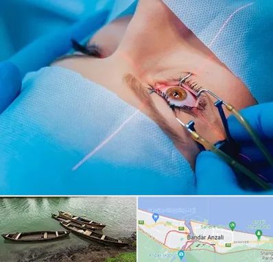 عمل prk چشم در بندر انزلی