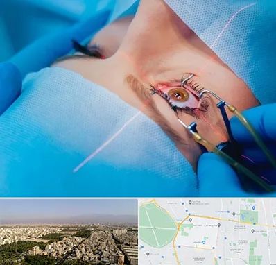 عمل prk چشم در نازی آباد 