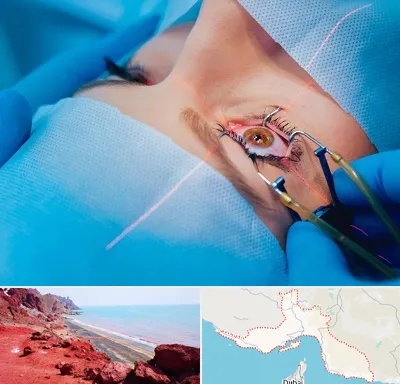 عمل prk چشم در هرمزگان