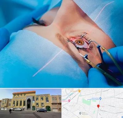 عمل prk چشم در زنبیل آباد قم