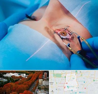 عمل prk چشم در منطقه 6 تهران 