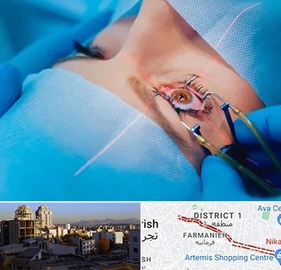 عمل prk چشم در فرمانیه 