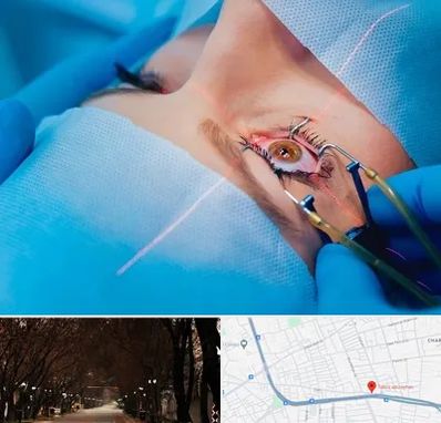 عمل prk چشم در ابوریحان تبریز