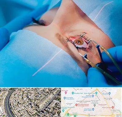 عمل prk چشم در شهرک غرب مشهد