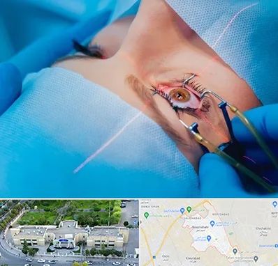 عمل prk چشم در نسیم شهر