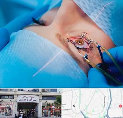 عمل prk چشم در ایران زمین