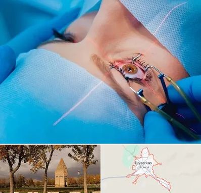 عمل prk چشم در تویسرکان