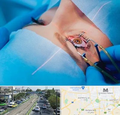 عمل prk چشم در جنوب تهران 