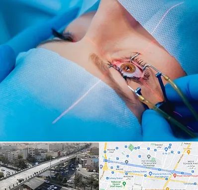 عمل prk چشم در فرجام