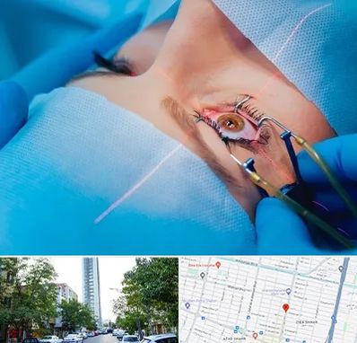 عمل prk چشم در امامت مشهد