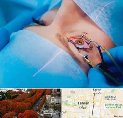 عمل prk چشم در ولیعصر 