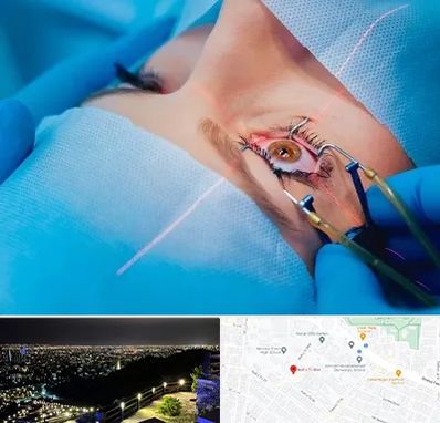 عمل prk چشم در هفت تیر مشهد 