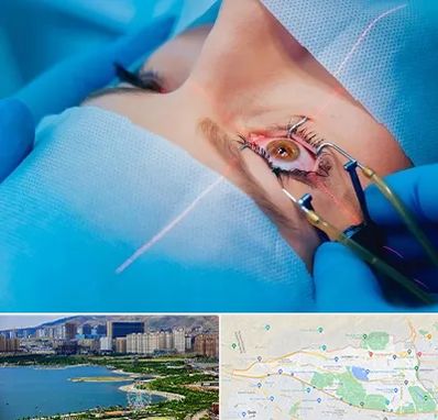 عمل prk چشم در منطقه 22 تهران 