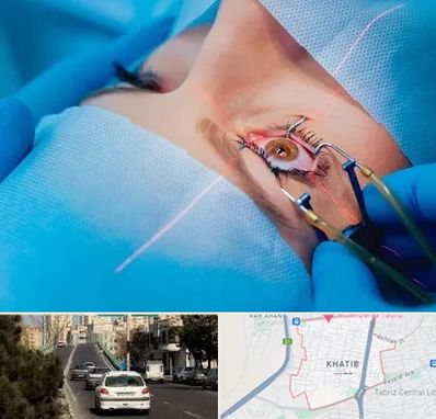 عمل prk چشم در خطیب تبریز