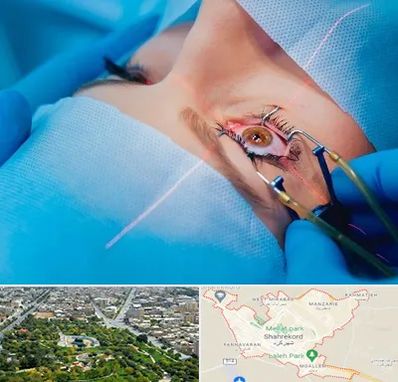 عمل prk چشم در شهرکرد