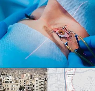 عمل prk چشم در اسکندری