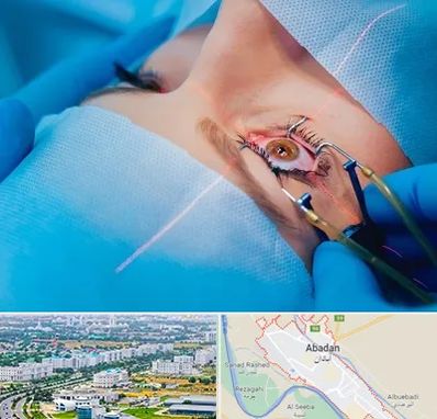 عمل prk چشم در آبادان