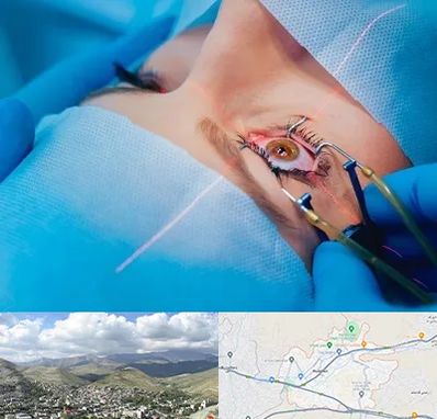 عمل prk چشم در رودهن