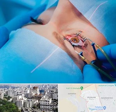 عمل prk چشم در ولنجک 