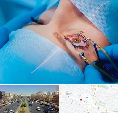 عمل prk چشم در بلوار معلم مشهد 