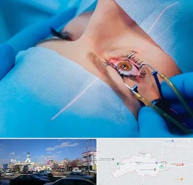 عمل prk چشم در ماهدشت کرج 