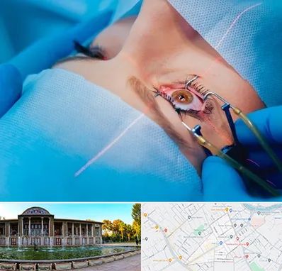 عمل prk چشم در عفیف آباد شیراز