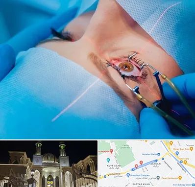 عمل prk چشم در زرگری شیراز