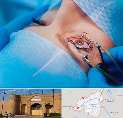 عمل prk چشم در ایرانشهر