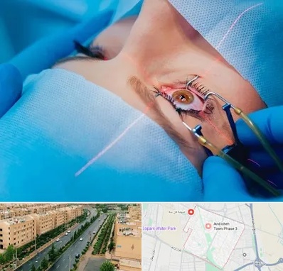 عمل prk چشم در فاز سه اندیشه