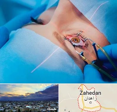 عمل prk چشم در زاهدان