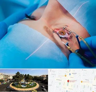 عمل prk چشم در هفت حوض 