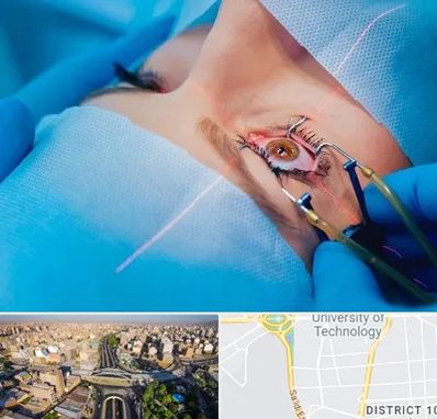 عمل prk چشم در استاد معین 