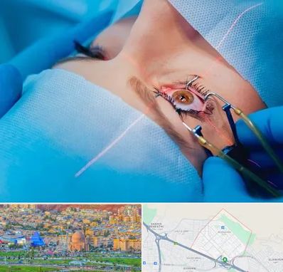 عمل prk چشم در رشدیه تبریز