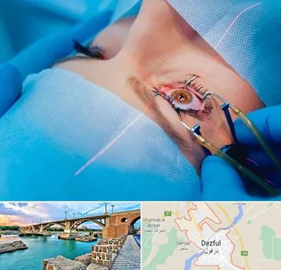 عمل prk چشم در دزفول