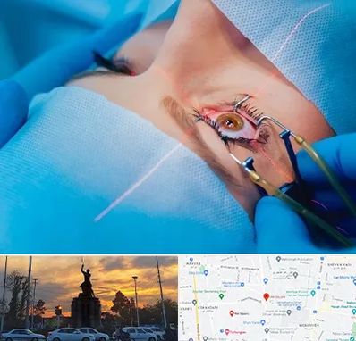 عمل prk چشم در میدان حر 