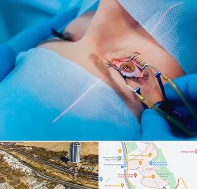 عمل prk چشم در خیابان نیایش شیراز