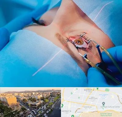 عمل prk چشم در تهرانپارس 